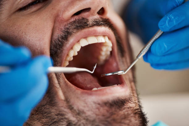 Best Urgent Care for Lost Fillings or Crowns in Wescosville, PA